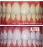 teeth whitening gelเหมาะสำหรับคนที่มีเวลาจำกัดเดินทางบ่อย ฟันขาวปิ๊งแบบดาราได้ใน 3วันไม่ต้องใช้เครื่องฉายแสงเคล็ดลับฟันขาวของดารา